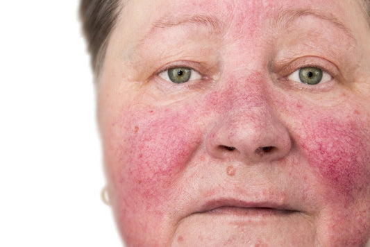 Understanding Rosacea: Symptoms, Triggers, and Treatment Options - Bee Naturals